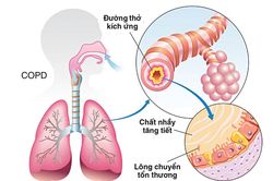 Làm gì khi bị bệnh phổi tắc nghẽn mạn tính?