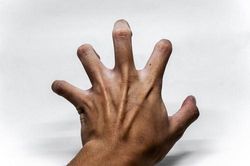 Người đàn ông lên cơn co giật 20 lần mỗi ngày vì sán làm tổ trong não