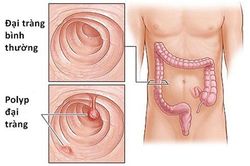 Phòng ngừa táo bón ở người cao tuổi