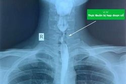 Uống nhầm chất tẩy rửa, bệnh nhân bị bỏng thực quản