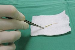 Ăn cá kìm, người phụ nữ bị xương đâm thủng ruột non