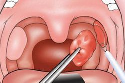Cảnh báo những rủi ro có thể gặp phải khi cắt amidan