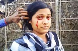 Hội chứng kỳ lạ khiến người bệnh 'khóc ra máu'
