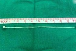 Người đàn ông Trung Quốc đau đầu suốt 30 năm vì giun kẹt trong não
