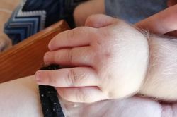 17 trẻ mắc hội chứng 'người sói' sau khi uống thuốc dạ dày