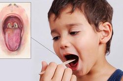 Những điều cần biết về bạch hầu - căn bệnh có thể gây tử vong trong 6 ngày