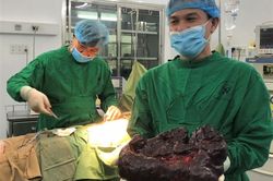 Bác sĩ lần đầu gặp khối u lách nặng hơn 5 kg
