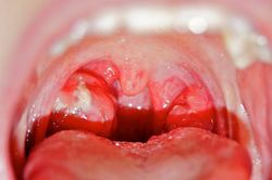 Viêm họng khi giao mùa - bệnh thường gặp, biến chứng nguy hiểm