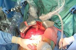 Bệnh viện Trung ương Huế lập kỷ lục thực hiện 21 ca ghép tạng trong vòng một tháng