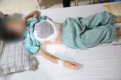Ngực lở loét, hoại tử sau khi chữa bệnh ở thầy lang