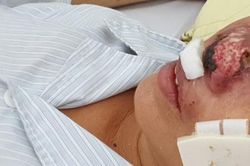 Người phụ nữ bị ăn mòn cánh mũi bởi 'vi khuẩn lãng quên'