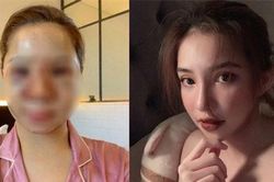 Lưu Đê Ly công khai quá trình phẫu thuật thẩm mỹ, diện mạo sau 2 tháng gây bất ngờ