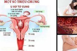 Những đối tượng nào có nguy cơ mắc u xơ cơ tử cung?