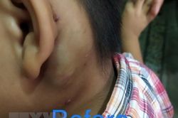 Điều trị cho bệnh nhi bị u máu dạng dị dạng tĩnh mạch sau tai