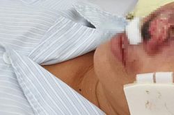 Vi khuẩn ăn thịt người Whitmore có thể gây tử vong trong vòng 48 tiếng