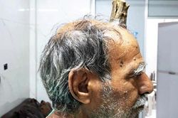 Người đàn ông có 'sừng quỷ' dài 10 cm mọc trên đỉnh đầu