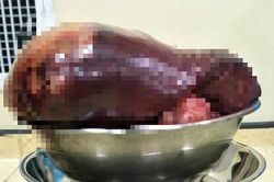 Thanh niên 24 tuổi mang khối u lách 2,3kg, bác sĩ cảnh báo triệu chứng cần kiểm tra ngay