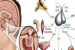 Dấu hiệu bị u tuyến yên, nhiều người có mà không biết