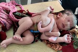 Mẹ bầu không siêu âm, sinh ra con có 3 tay 4 chân ở Ấn Độ