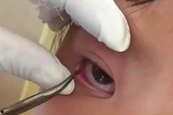 Phẫu thuật lấy con vắt từ mắt bé gái