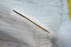 Ngủ quên, người đàn ông nuốt que tăm nhọn vào bụng