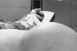 Bụng to như mang thai 9 tháng, cụ bà ở Hà Giang đi khám phát hiện khối u khổng lồ