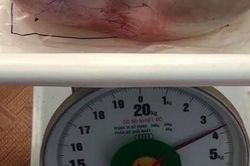 Người phụ nữ 67 tuổi mang khối u buồng trứng nặng 3,7kg