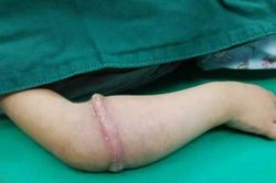 Tay bé gái biến dạng vì chiếc nịt cao su