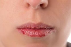 Những dấu hiệu trên môi cảnh báo bệnh nguy hiểm