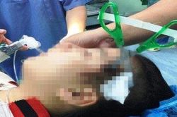 Cứu sống bé gái 10 tuổi bị kéo đâm vào đầu
