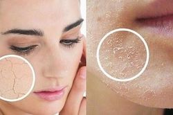 Bác sỹ da liễu bày cách đơn giản khiến bạn không bị da khô, nứt nẻ trong những ngày thu hanh