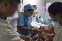 Tách dính cặp song sinh nhỏ nhất từ trước tới nay tại bệnh viện Nhi đồng 1