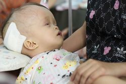 Bé gái một tuổi đầu to, úng nước vì dị tật bẩm sinh ở não