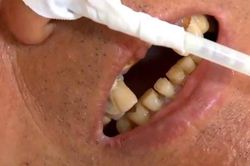 Nhập viện cấp cứu vì nuốt phải răng giả trong khi ăn cháo