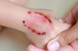 Bệnh dại ở người: Thoát khỏi nguy cơ tử vong nhờ điều trị đúng cách
