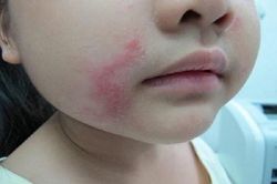 Nhiều khu vực lại xuất hiện kiến ba khoang, người dân coi chừng nhiễm độc