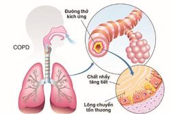 Ghép tế bào gốc tự thân để điều trị bệnh phổi tắc nghẽn mạn tính