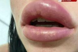 Người phụ nữ suýt bị mù vì đôi môi 'phát nổ'