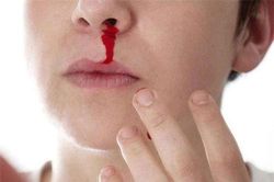 Chảy máu cam: Hãy nhanh chân đến gặp bác sĩ để 'chặn cửa' căn bệnh nguy hiểm