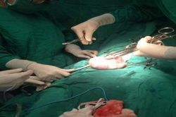Hút 2 lít dịch từ khối u nang 'khủng' của người phụ nữ