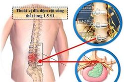 Chỉ mặt điểm tên 'sát thủ' gây thoát vị nghĩa đệm, số 1 vô cùng 'quen mặt'