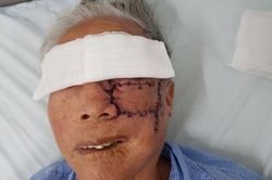 Cắt khối u sùi loét, tạo hình thành công má trái cho cụ ông 91 tuổi