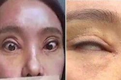 Mất tiền nâng mí mắt, cô gái nhận kết cục thảm thương