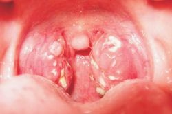 Điều trị cách ly bé trai 7 tuổi ở Quảng Ngãi bị bệnh bạch hầu