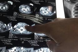 Cháu bé nhỏ tuổi nhất từ trước đến nay được phát hiện ung thư tuyến giáp thể hiếm gặp