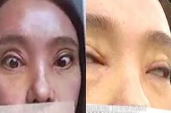 Nghịch cảnh: Tốn tới 40 triệu để cắt mí nhưng cô gái không thể nhắm mắt khi ngủ