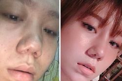 Vụ khách hàng tố Klain Beauty làm hỏng mũi: Công ty Klain dính phạt nhiều vi phạm