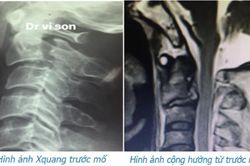 Phẫu thuật thành công bệnh nhân bị chấn thương cột sống cổ hiếm gặp