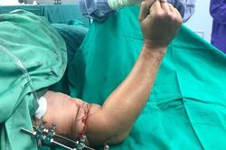 Cánh tay bị cắt đứt rời, nan thanh niên may mắn được nối lại thành công