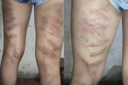 Không học thuộc bài, nữ sinh tiểu học bị cô dùng roi đánh dã man